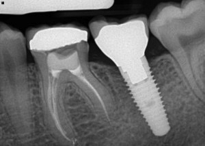 Dental implant xray