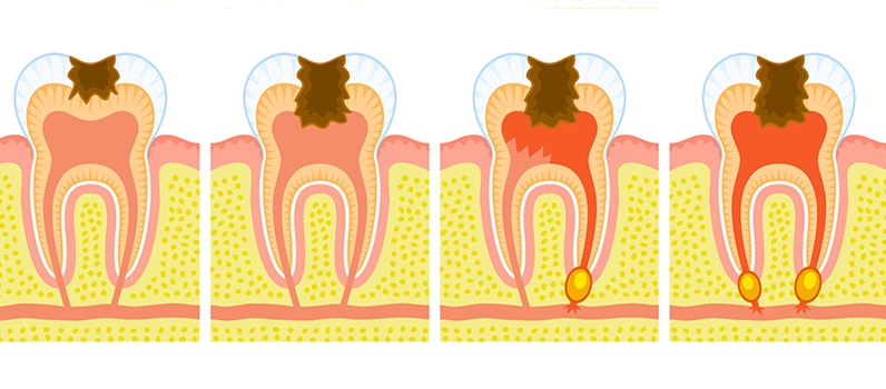 ToothDecay