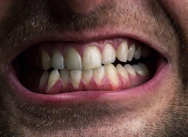 Bruxism