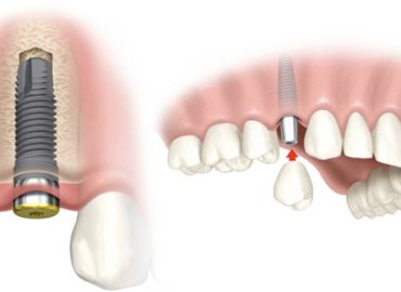 Dental implants