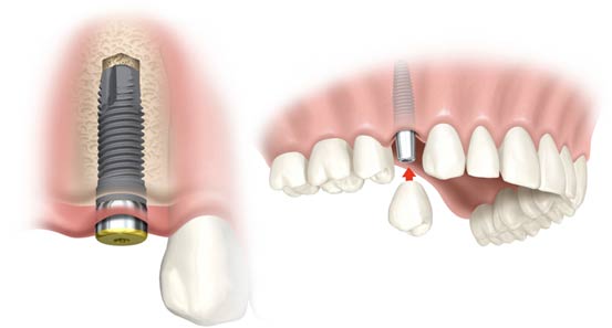 Dental implants