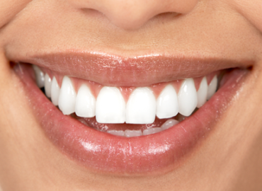 teeth-whitening