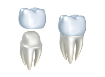 Dental-crown1