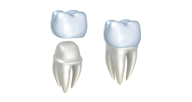 Dental-crown1