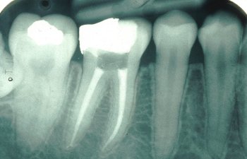 Endo treated tooth