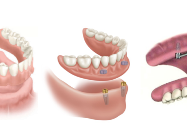 Implant dentures