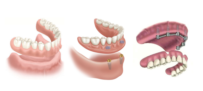 Implant dentures