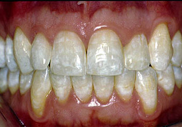 Mild Fluorosis