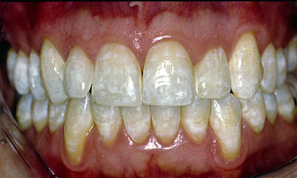 Mild Fluorosis