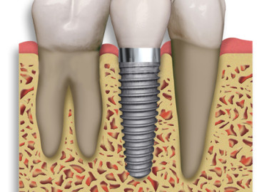 Dental-Implant