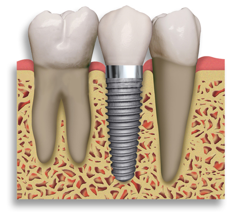 Dental-Implant