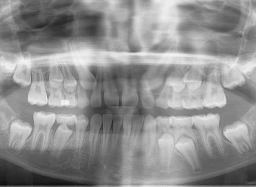 xray mixed dentition OPG