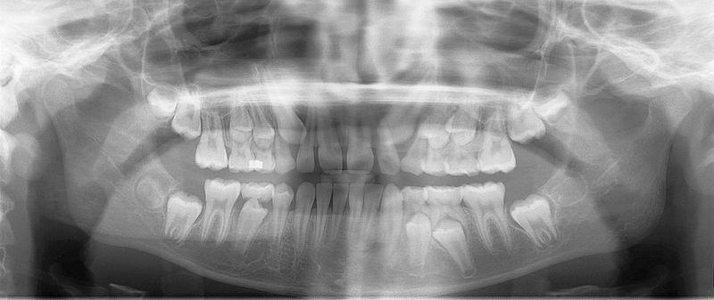 xray mixed dentition OPG