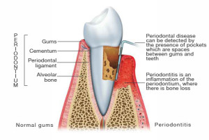 periodontitis_illustration