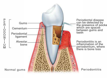 periodontitis_illustration