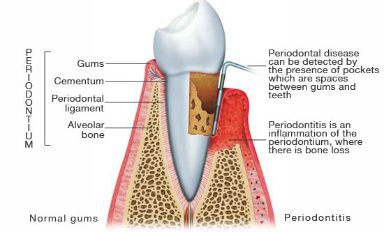 periodontitis_illustration