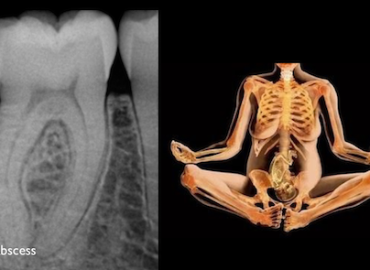 X-rays in pregnancy