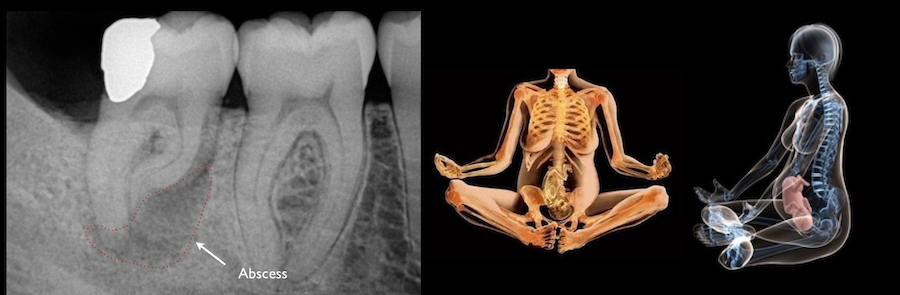 X-rays in pregnancy