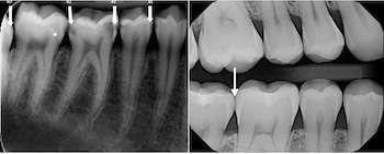 Dental x-rays bitewings